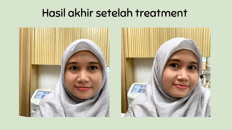 photo facial glow zap